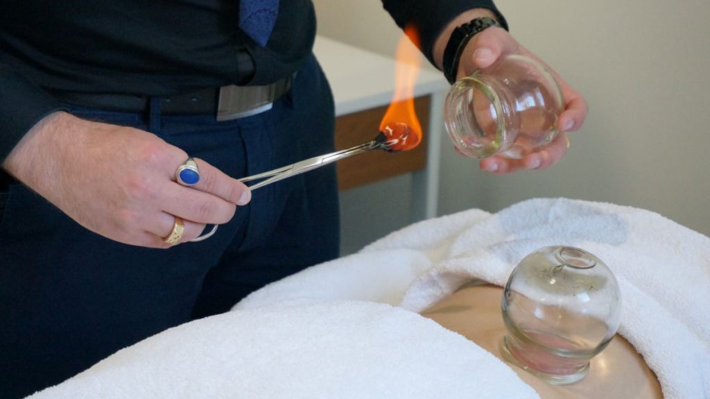 Cupping Therapy Benefits: Discover Healing in Melbourne