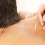 Acupuncture and Cupping: Enhance Your Sports Recovery