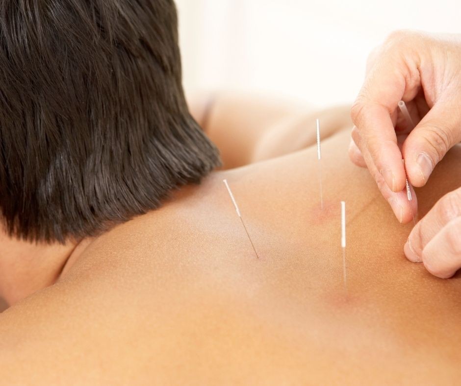 Acupuncture and Cupping: Enhance Your Sports Recovery